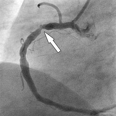 coronary angiography w lhc possible pci